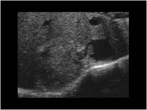 Transverse image of a mass in the right upper abdomen caudal to the liver. Part of the mass extends in the inferior vena cava.