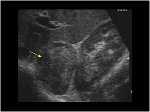 Longitudinal image of the mass. The lesion is located between the liver and the upper pole of the right kidney.