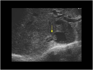 Transverse image of the inferior vena cava. There is tumor in the adrenal vein extending in the inferior vena cava.