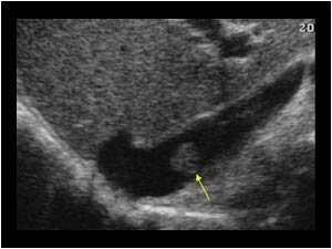 Longitudinal image of the inferior vena cava. There is a tumor mass in the inferior vena cava.