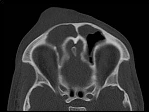 CT image showing a frontal sinusitis and soft tissue swelling anterior of the right frontal sinus.