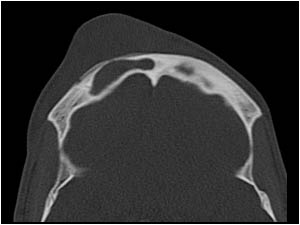  CT image at a higher level showing thinning of the anterior wall of the right frontal sinus.
