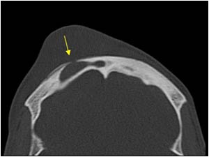 CT image at a higher level showing thinning of the anterior wall of the right frontal sinus and the bony defect.