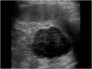 Transverse image of a hypoechoic mass at the upperpole of the left kidney.