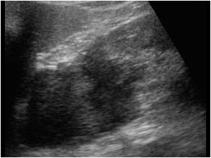 Longitudinal image of the hypoechoic mass at the upperpole of the left kidney invading the kidney.