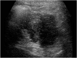 Transverse image of the hypoechoic mass at the upperpole of the left kidney invading the kidney.