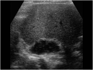 Transverse image of the same patient showing a smaller hypoechoic mass at the upperpole of the right kidney.