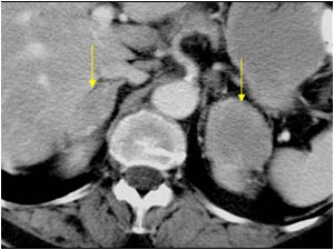 CT image showing the two masses a the upper poles of the kidneys.