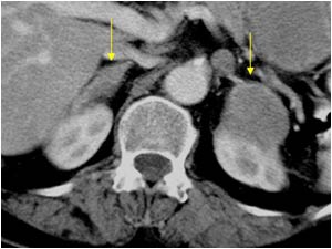 CT image at a lower level showing the two masses at the upper poles of the kidneys. The left one invading the kidney.