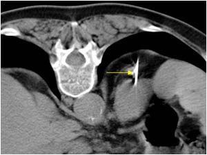  CT image of a CT guided biopsy showing the needle in the mass in the upperpole of the left kidney.

The biopsy proved the mass to be a metastasis of a lung carcinoma.