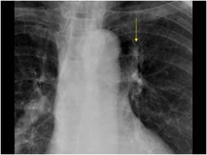 An X ray of the chest shows a small lung carcinoma confirmed with bronchoscopy.