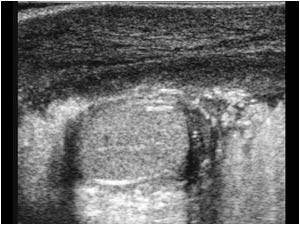 Longitudinal image of the right scrotum with a normal testicle and peritesticular structures. No hydrocele. The right scrotal wall is markedly thickened.