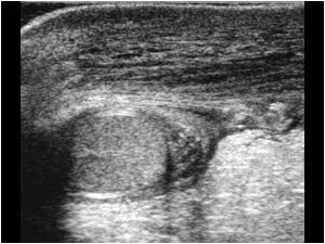 Longitudinal image of the left scrotum also with a normal testicle and peritesticular structures. No hydrocele. The left scrotal wall is markedly thickened.