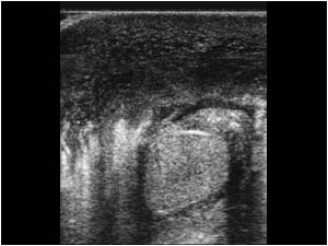 Transverse image of the right testicle with the same findings.