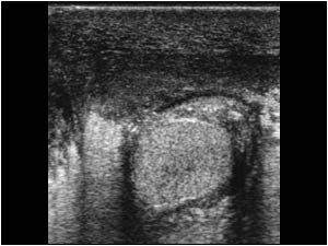 Transverse image of the left testicle also with the same findings.