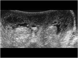Convex transverse image showing an edematous scrotal wall and normal testicles and peritesticular structures.