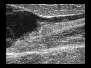 Longitudinal image of the distal end of the mass and the greater saphenous vein.