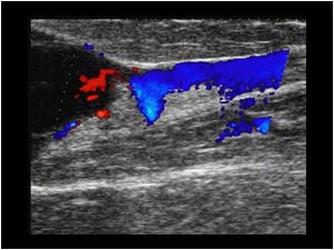 Longitudinal color doppler image of the distal end of the mass and the greater saphenous vein. The vein is still patent.