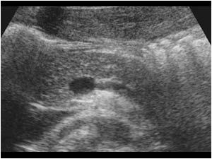 Transverse image of the normal pancreas.

With the information so far, do you think the jaundice is caused by obstruction caused by gallstones?