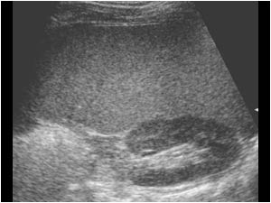 Transverse image of the left kidney and enlarged spleen.