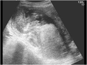 Longitudinal image of the partly cystic and partly solid mass of more than 10 cm in the right lower abdomen.