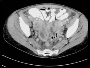 Two CT scan images of the same patient made a few month earlier when the patient was admitted under suspicion of having a pelvic inflammatory disease or an appendicitis . The images show a smaller irregular mass with cystic areas. A laparoscopy was perfor