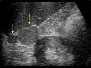 Image of the upperpole of the right kidney with two circumscribed lesions between the kidney and right liver lobe.