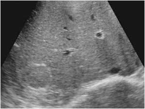 Transverse image of one of the lesions caudal of the right liver lobe.