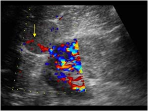  Color doppler image of the kidney and one of the lesions shows vascularization of the mass.

During examination no spleen could be found. Patient had undergone a splenectomy as a child after an abdominal trauma with a splenic rupture.

This informati