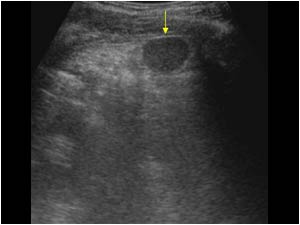 Image of the left flank in another patient with an accessory spleen after splenectomy.