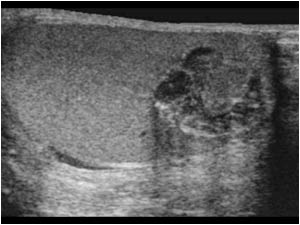 Inhomogeneous cystic lesion in the right testicle