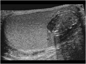 Extended field of view image of the testis and the lesion.