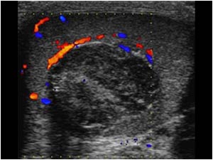 With color doppler there is only vascularity around the lesion but not within the lesion.