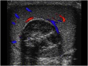 Again the same findings with color doppler. Note that there is some acoustic shadowing.

How would you interpret the findings? Is the lesion probably benign or malignant?

Compare the images with the next two cases: