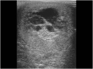 Partly cystic lesion in the testis of a 49 year old male
