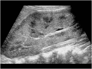 Longitudinal image of the enlarged right kidney. The kidney measures more than 14 centimeter. There is loss of definition and distortion of the renal sinus echo complex.