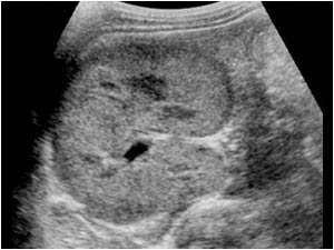Transverse image of the enlarged right kidney.