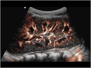 E flow image of the left kidney. The vascularity of the kidneys is normal.