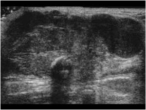 The mass has an irregular contour and contains some calcifications