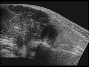 Extended field of view image of the ill defined mass in the parotid gland