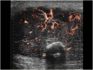 Image of the mass with e-flow. There is a very irregular vascularity.