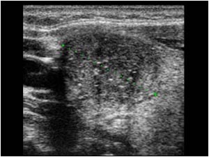 Transverse image of a hypoechoic mass in the right thyroid lobe with punctate calcifications