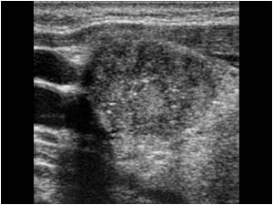 Transverse image of the same mass with ill defined contour and punctate calcifications