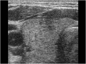 Transverse image of the rest of the right thyroid lobe without abnormality