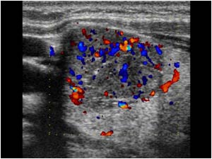 Color doppler image of the mass in the right thyroid lobe with irregular vascularity