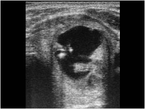 Transverse image of the left thyroid lobe with a partly cystic mass
