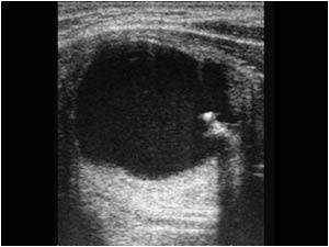 Longitudinal image of the left thyroid lobe with the same partly cystic mass