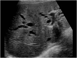 Transverse image of the liver with dilatated intrahepatic bile ducts