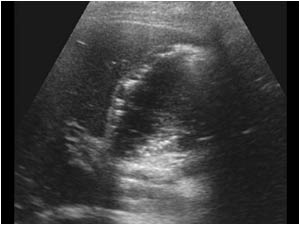 Longitudinal image of the gallbladder with highly reflective structures within the gallbladder causing acoustic shadowing. The bile ducts are normal.