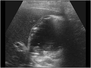 Longitudinal image of the gallbladder. The wall is thickened, suggestive for a cholecystitis. There are gravity dependent and non gravity dependent echos within the gallbladder.